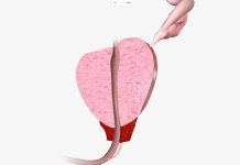 面對攝護腺癌 積極診斷 輕鬆治療 (圖/示意圖)