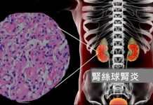 什麼是腎絲球腎炎 (圖/臺北市立聯合醫院)