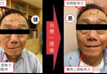 顏面神經麻痺 中醫針灸效果好