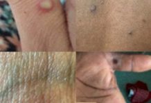 全球猴痘疫情大不同 歐與非傳播途徑相異