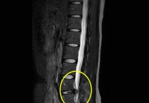 椎間盤突出使大小腿痠麻 選擇脊椎微創內視鏡治療快速又安全 圖/台北市政府提供