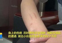 細思極恐!12歲女孩險被誘騙至緬甸 湖北年輕人趙先生說起2年前在緬北的遭遇,手仍抖個不停。2年前手上的疤,到現在還沒痊癒。圖/閃電視頻