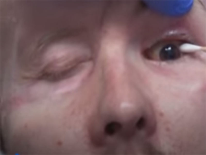 46歲工人詹姆斯接受全球首例全眼球移植手術。圖／擷取自網路影片