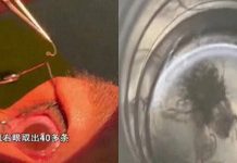 昆明女子眼中現驚人一幕!60多條寄生蟲現身 圖/翻攝自微博