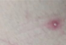 剛果及非洲M痘病例激增 WHO宣布全球公共衛生緊急狀態 示意圖/台南市衛生局