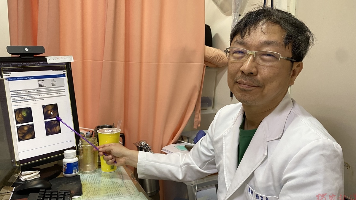69歲翁「消化道連環爆」狂解黑便 「膠囊內視鏡」深入6公尺小腸揪出隱形出血點 69歲翁「消化道連環爆」狂解黑便 「膠囊內視鏡」深入6公尺小腸揪出隱形出血點