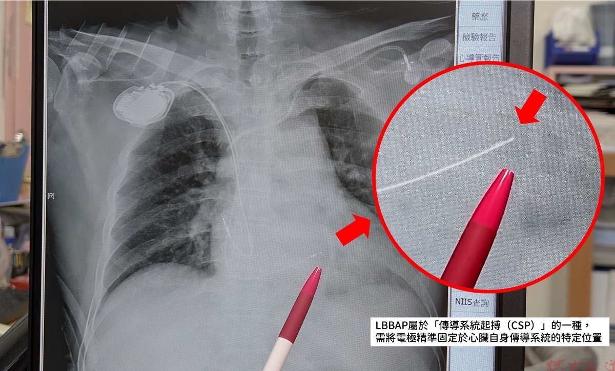 67歲男急性心肌梗塞合併嚴重傳導阻滯 安泰醫院完成LBBAP治療康復出院 67歲男急性心肌梗塞合併嚴重傳導阻滯 安泰醫院完成LBBAP治療康復出院
