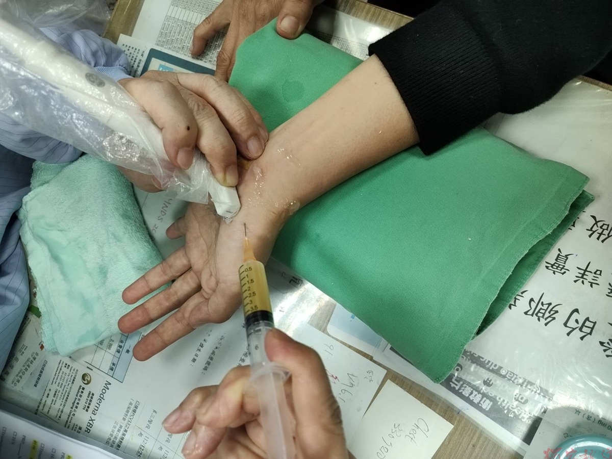 腕隧道手術後反而夜夜痛醒 超音波揪出神經沾黏 腕隧道手術後反而夜夜痛醒 超音波揪出神經沾黏