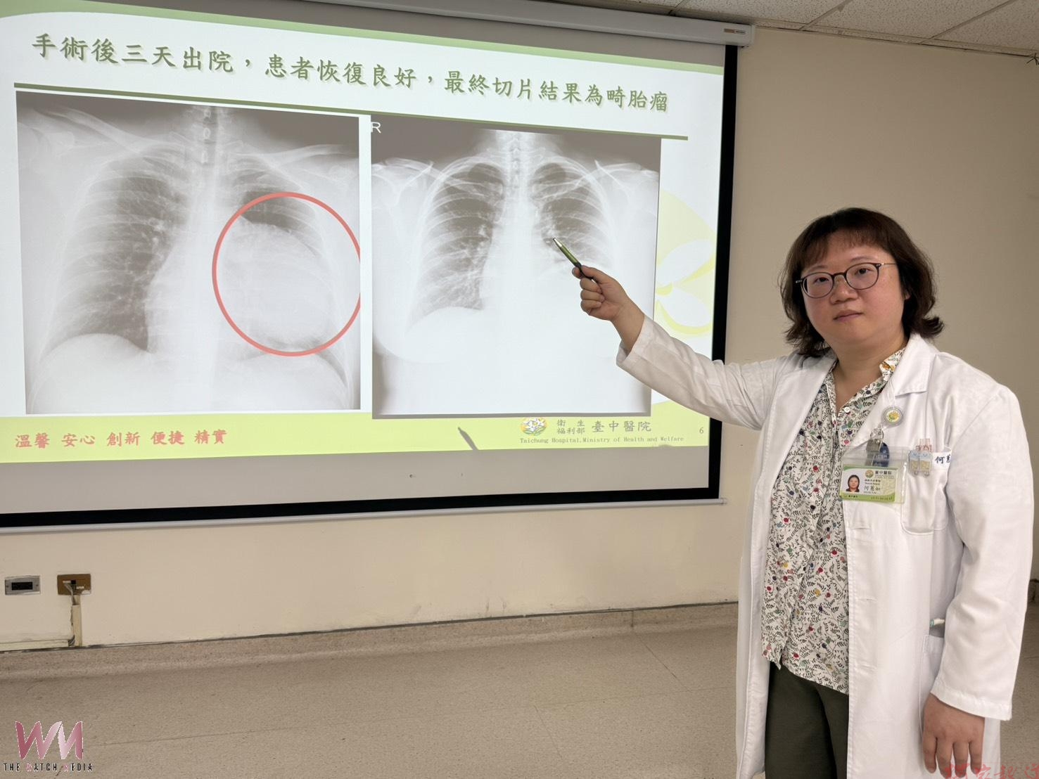 求職健檢驚見15公分腫瘤 24歲女接受胸腔鏡手術切除畸胎瘤 求職健檢驚見15公分腫瘤 24歲女接受胸腔鏡手術切除畸胎瘤