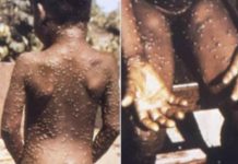 阿聯酋驚爆猴痘病例 繼以色列後中東第二國 被感染猴痘病毒患者,皮疹是一種臨床症狀。(圖片取材自網路维基百科)