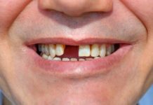 英研究證實缺牙及牙周病 增加癡呆病發率